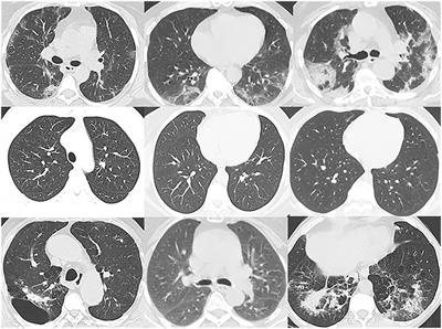 Analysis of CT scan images for COVID-19 pneumonia based on a deep ensemble framework with DenseNet, Swin transformer, and RegNet